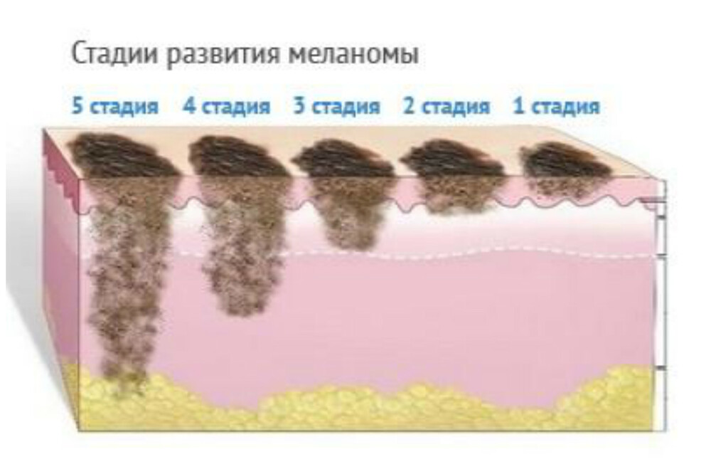 Уровни инвазии меланомы по кларку