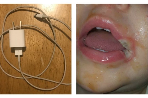 Ребёнок зacyнул зарядное устройство себе в рот и это превратилось в настоящий кошмар