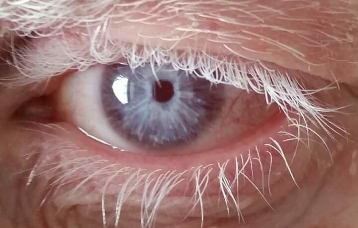 цвет глаз альбиноса в обычном состоянии