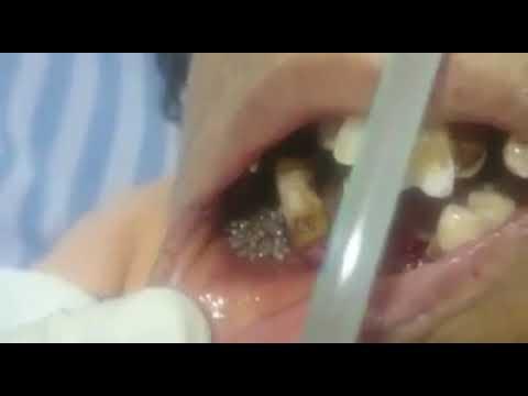 К стоматологу пришла пациентка с полным ртом личинок 