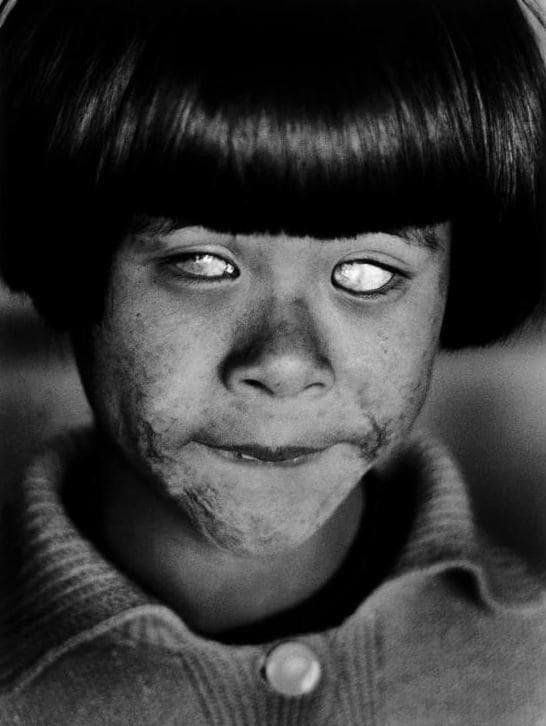 3. Глаза, которые видели ядерный взрыв в Хиросиме 