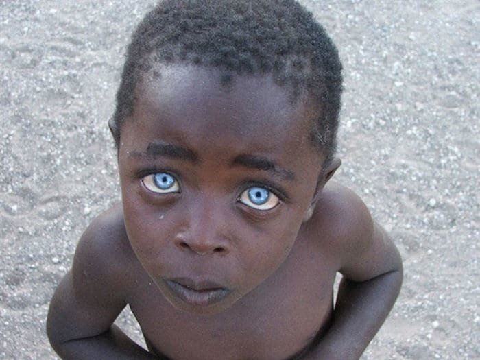 8. Невинность: африканский мальчик с невероятно редким цветом глаз
