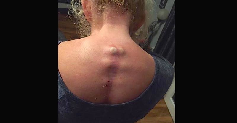 Женщина, страдающая сколиозом, демонстрирует мучения, причиняемые болезнью