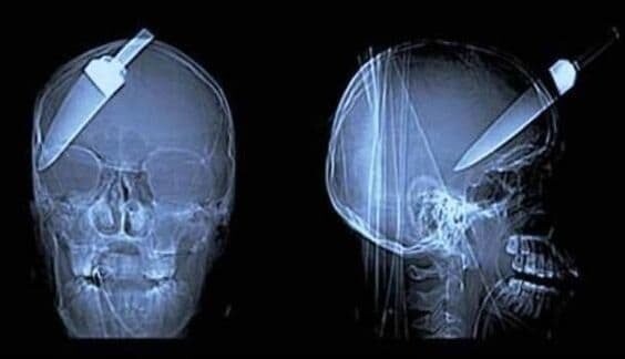 Даже врачи не сразу поверили в то, что увидели на этих рентгеновских снимках!