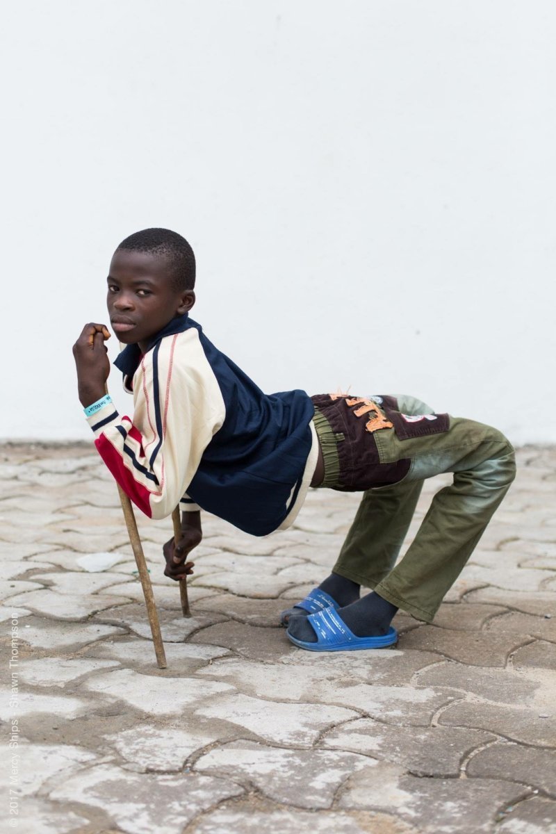 12-летний африканец с самого рождения страдал от деформации ног