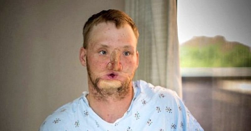 Через 10 лет после попытки самоубийства мужчина получил новое лицо