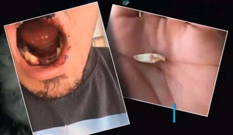 Парень лишился зубов и получил ожоги после взрыва электронной сигареты