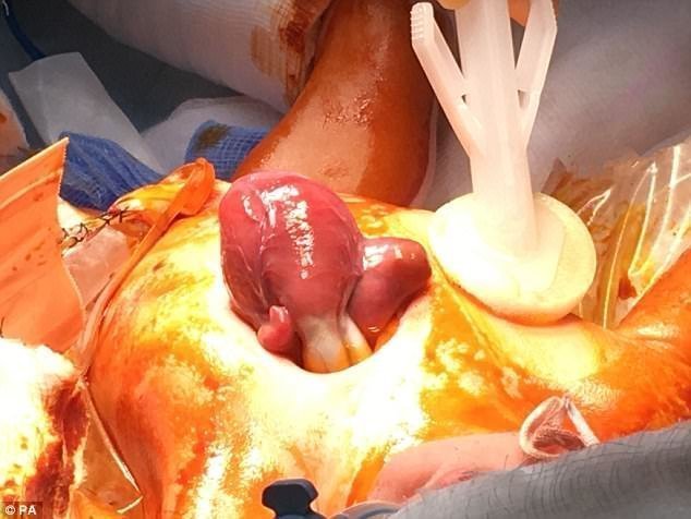 Девочка перенесла три сложнейших операции, первую из которых сделали через 50 минут после ее рождения. Врачам удалось успешно переместить сердце новорожденной в грудную клетку.