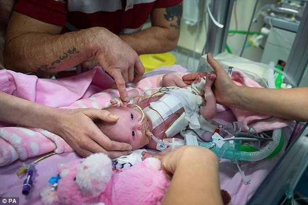 Британские врачи спасли девочку, родившуюся с сердцем вне тела