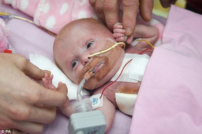 Британские врачи спасли девочку, родившуюся с сердцем вне тела