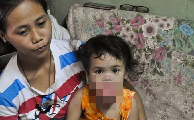 Маленькая девочка может умереть из-за опухоли на языке