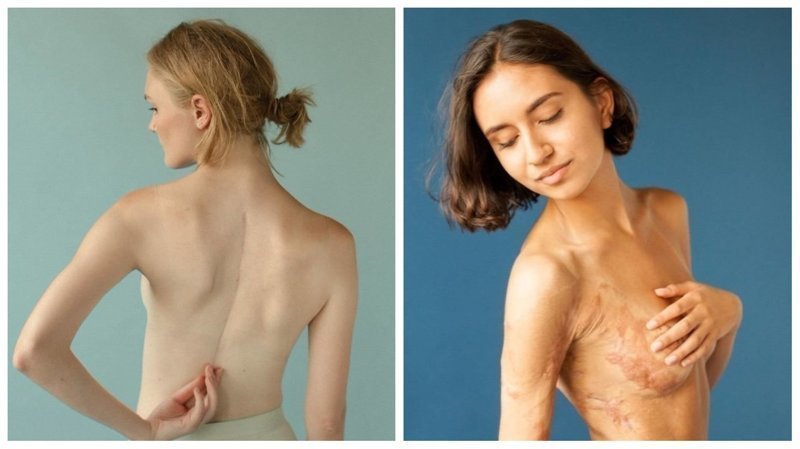 Фотопроект: люди показывают свои шрамы и рассказывают о том, как их получили