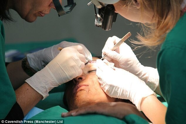 Операция представляет собой трансплантацию собственных волос пациента в область бровей