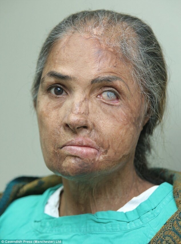 53-летняя Нияз Бано, владелица магазина из Пакистана, потеряла левый глаз после кислотного нападения во время скандала на свадьбе своей 16-летней дочери.