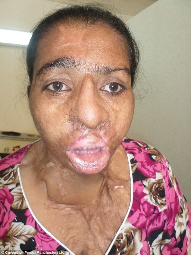 45-летняя Фатима Мунье, мать двоих детей, была облита серной кислотой во время семейной ссоры из-за денег. Она пыталась защитить себя, прикрывая лицо рукой, но в результате пострадало и ее лицо, и верхняя часть тела.