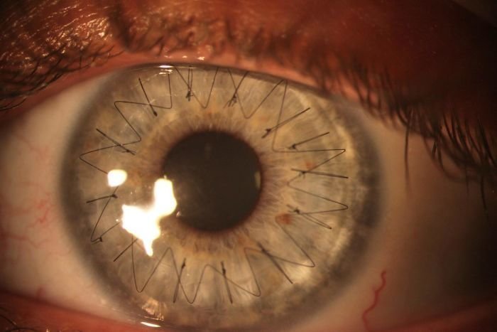 Вот так выглядит глаз после операции по пересадке роговицы