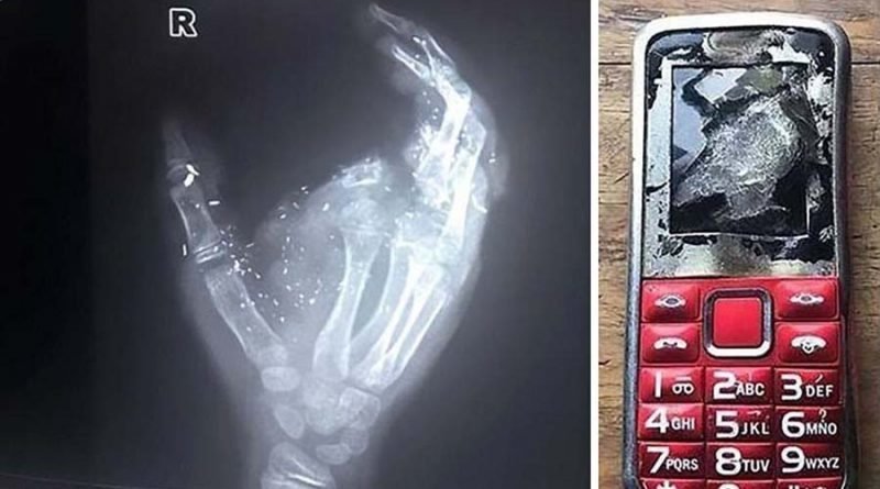 12-летний мальчик остался без пальца и ослеп на один глаз после того, как его телефон взорвался во время зарядки