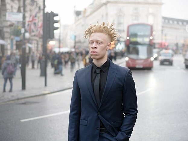 Модель-альбинос ответил тем, кто его травил, снявшись для Vogue