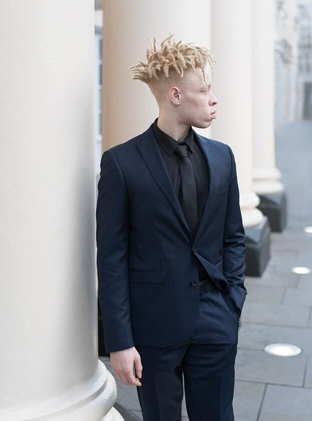 Модель-альбинос ответил тем, кто его травил, снявшись для Vogue