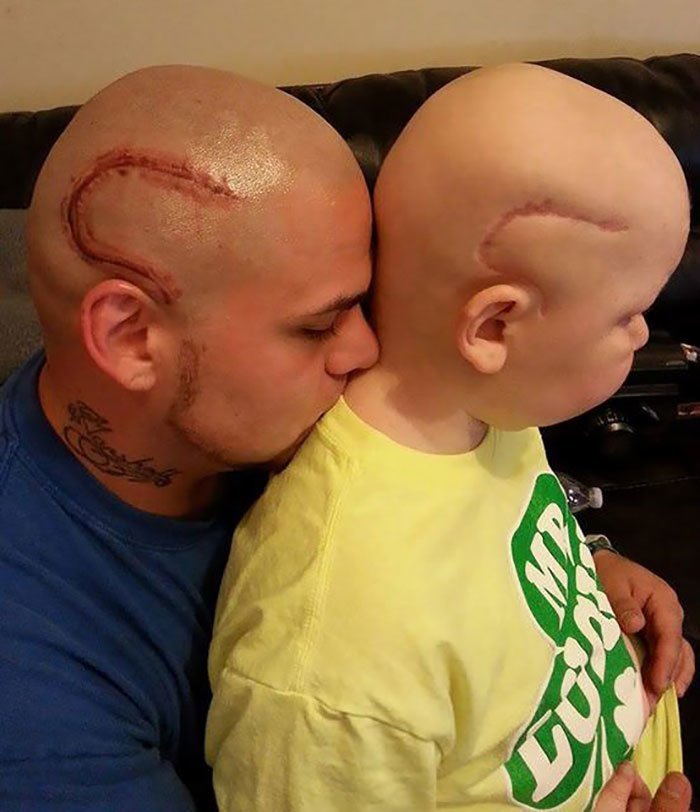 6. Отец "скопировал" шрам сына, страдающего от рака, чтобы поддержать его