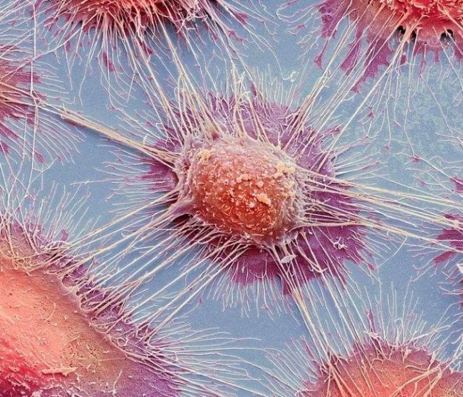 Раковая клетка под микроскопом