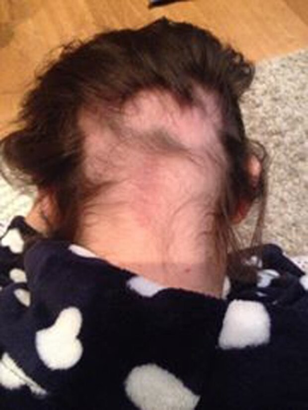 В 19 лет девушка осталась без единого волоска на голове и теле