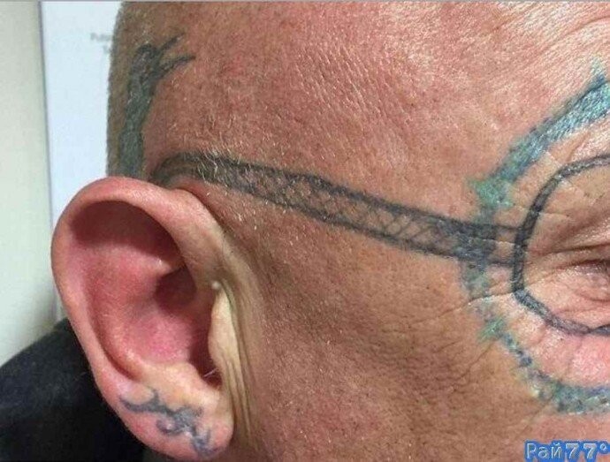 Мужчина решил избавиться от татуировки в виде очков на своём лице
