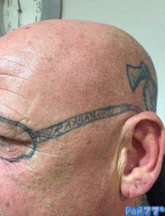Мужчина решил избавиться от татуировки в виде очков на своём лице
