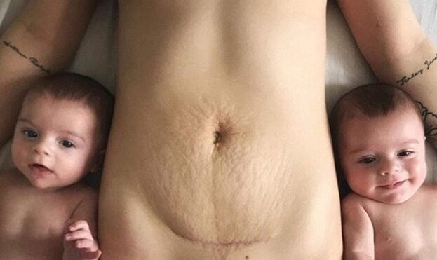 Мать близнецов показала миру шрам от операции, чтобы призвать женщин не стесняться своего тела