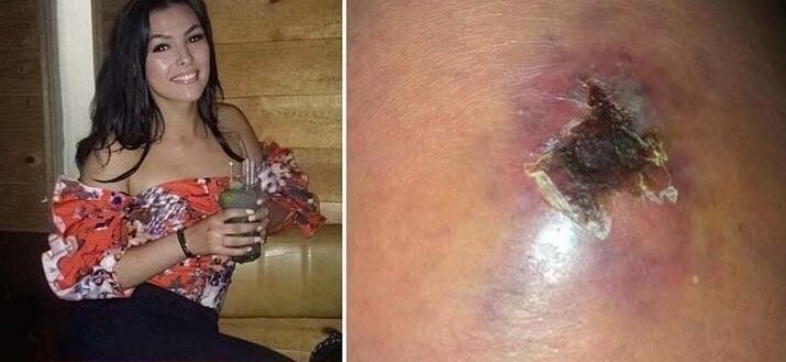 Страх потерять ногу после укуса паука заставил 19-летнюю девушку обратиться к врачам