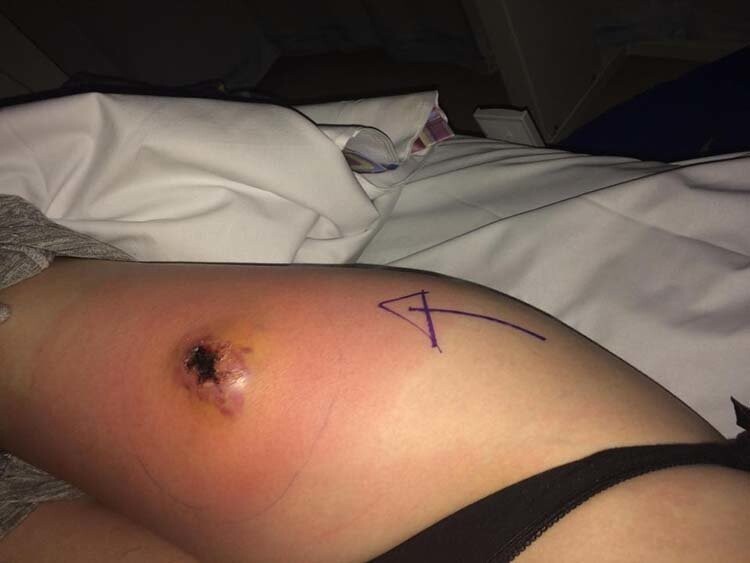 Страх потерять ногу после укуса паука заставил 19-летнюю девушку обратиться к врачам