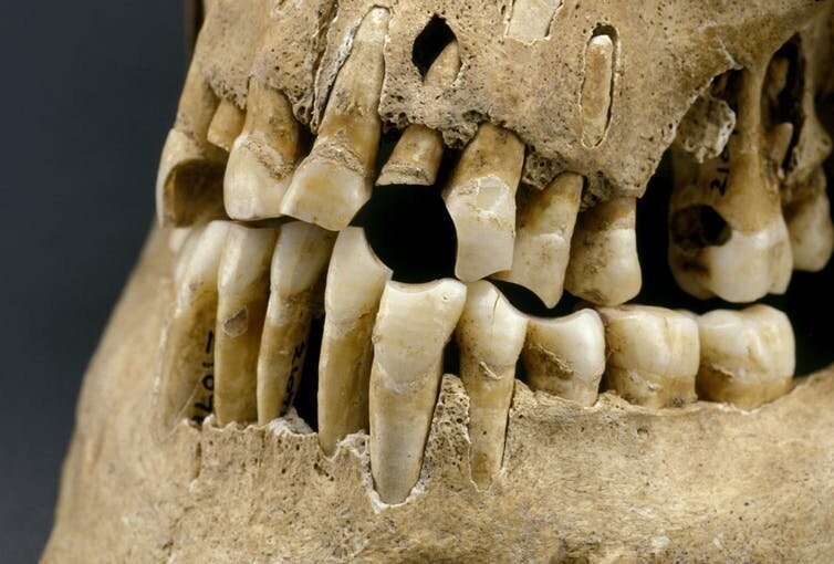 Сахар ни при чем: у наших древних предков были такие же проблемы с зубами