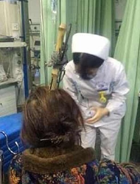Китайские врачи извлекли из головы женщины гигантские ножницы