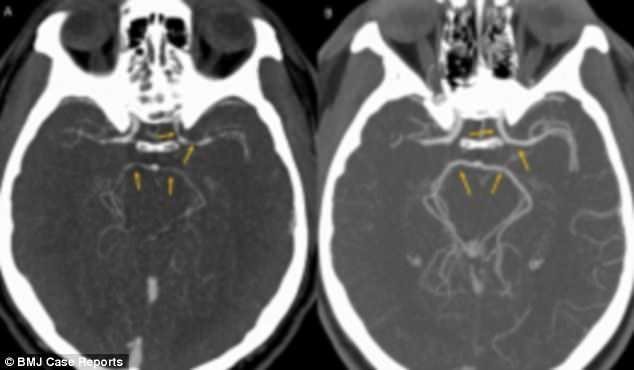 Результаты компьютерной томографии мозга: слева - при поступлении, справа - 5 недель спустя.