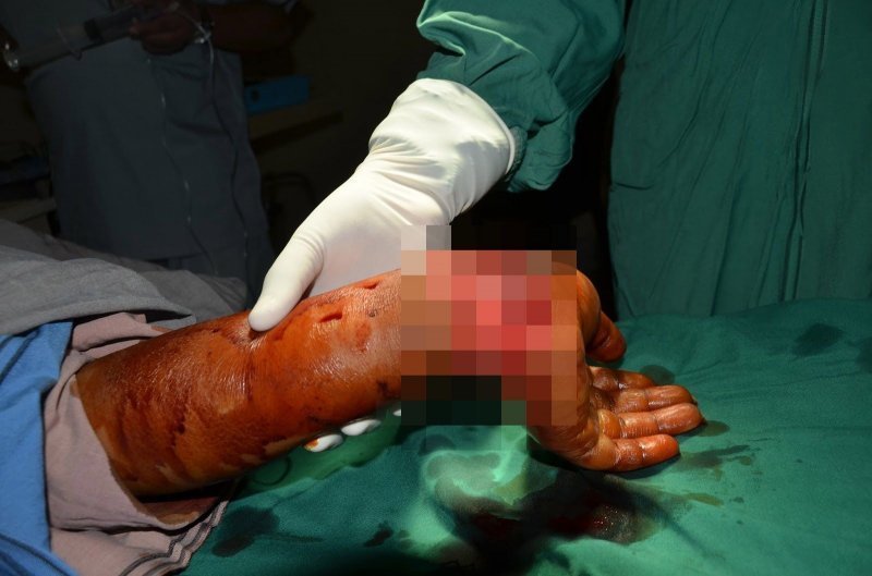 Хирурги спасли отрубленную кисть молодой девушки