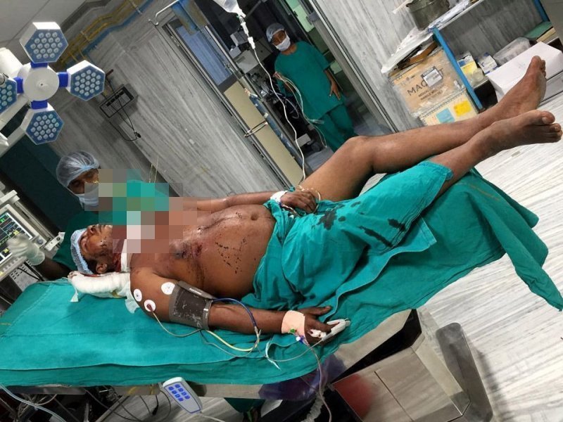 Бамбук насквозь пронзил тело водителя, но врачам удалось спасти мужчину