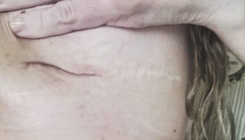 Женщина возненавидела свои грудные импланты и самостоятельно вырезала силикон из груди