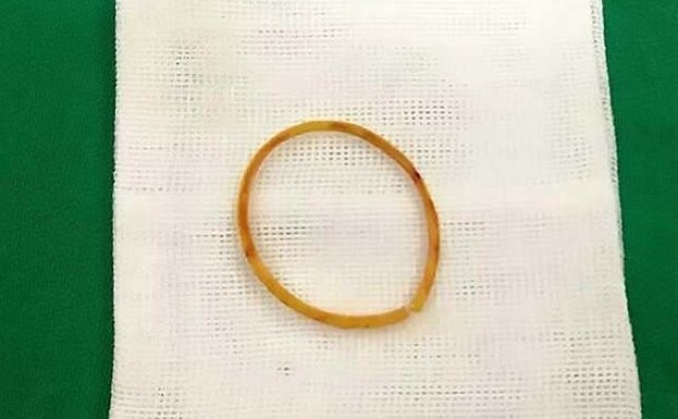 Китайским врачам пришлось хирургически удалять резиновое кольцо, вросшее ребенку под кожу