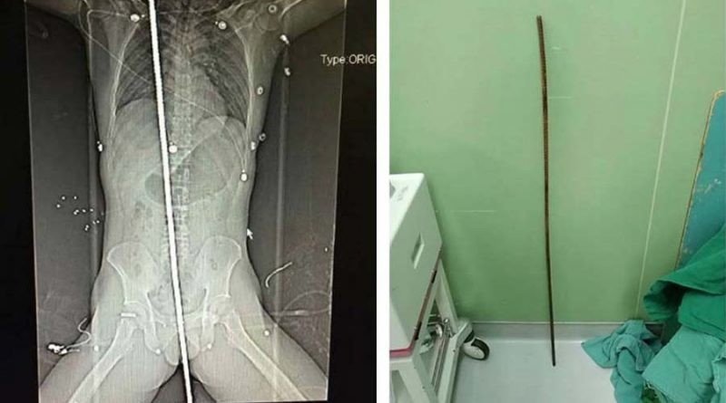 Выживший китайский строитель, упавший на арматуру, проткнувшую его насквозь через все тело