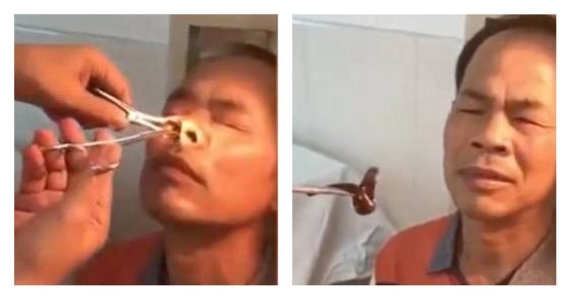 Из носа китайца извлекли огромную пиявку: видео