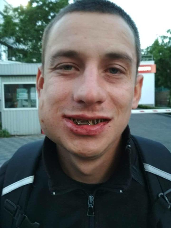 В результате избиения мужчина получил перелом челюсти и многочисленные ушибы