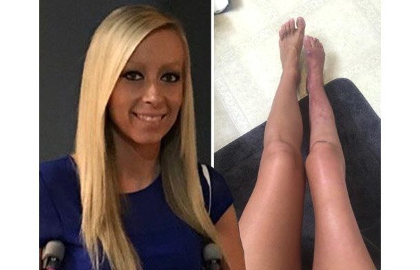 Женщина ампутировала свою ногу, которую скрывала от взглядов посторонних 20 лет