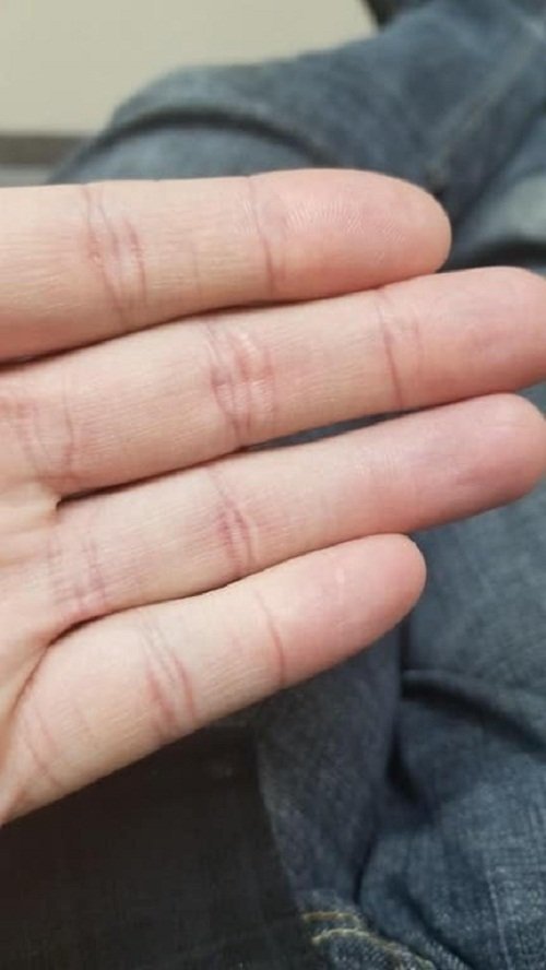 Сустав указательного пальца без складок кожи на верхней костяшке