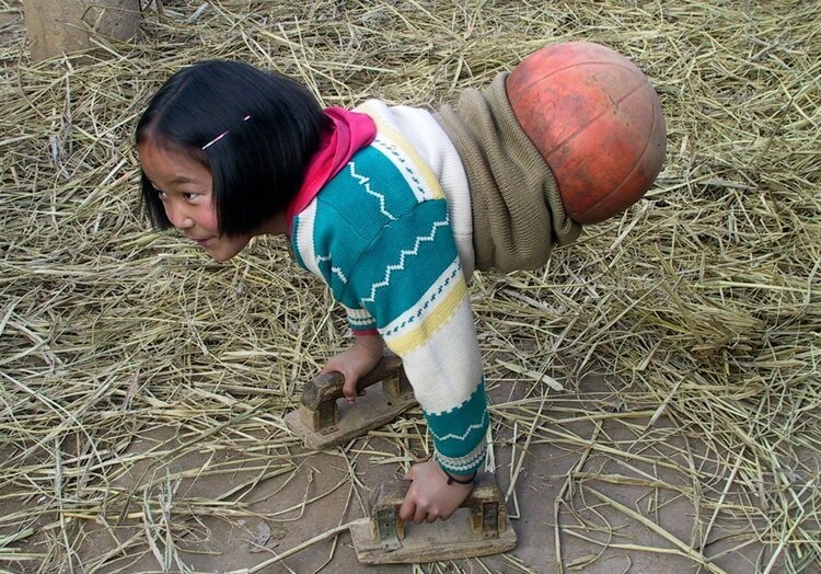 Девочка с баскетбольным мячом вместо ног стала известной спортсменкой