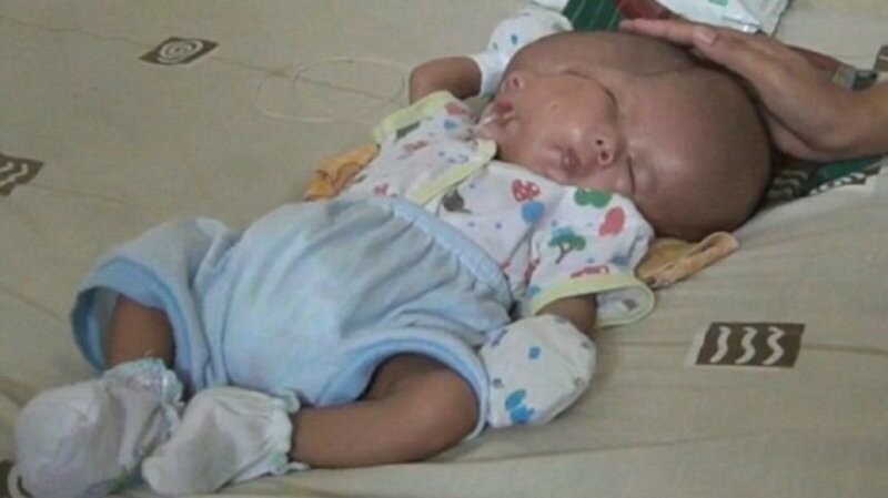 В Индонезии родился ребенок с двумя лицами