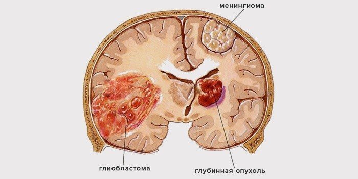 Свершилось! Медики "убили" неизлечимый рак крови и печени