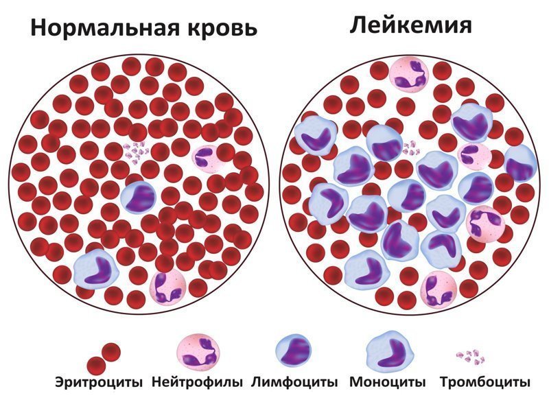 Рак крови ( лейкемия )