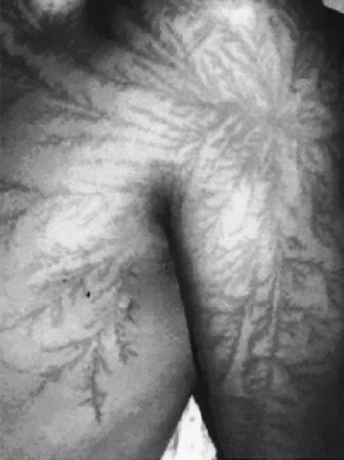 Фигуры Лихтенберга - картины распределения искровых каналов на поверхности диэлектрика (кожных покровов человеческого тела) при скользящем искровом разряде