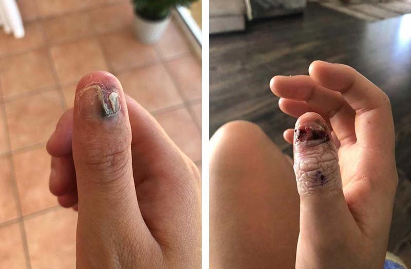 Её привычка грызть ногти привела к ампутации пальца