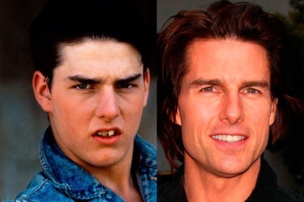 Том Круз до и после выравнивания зубов.